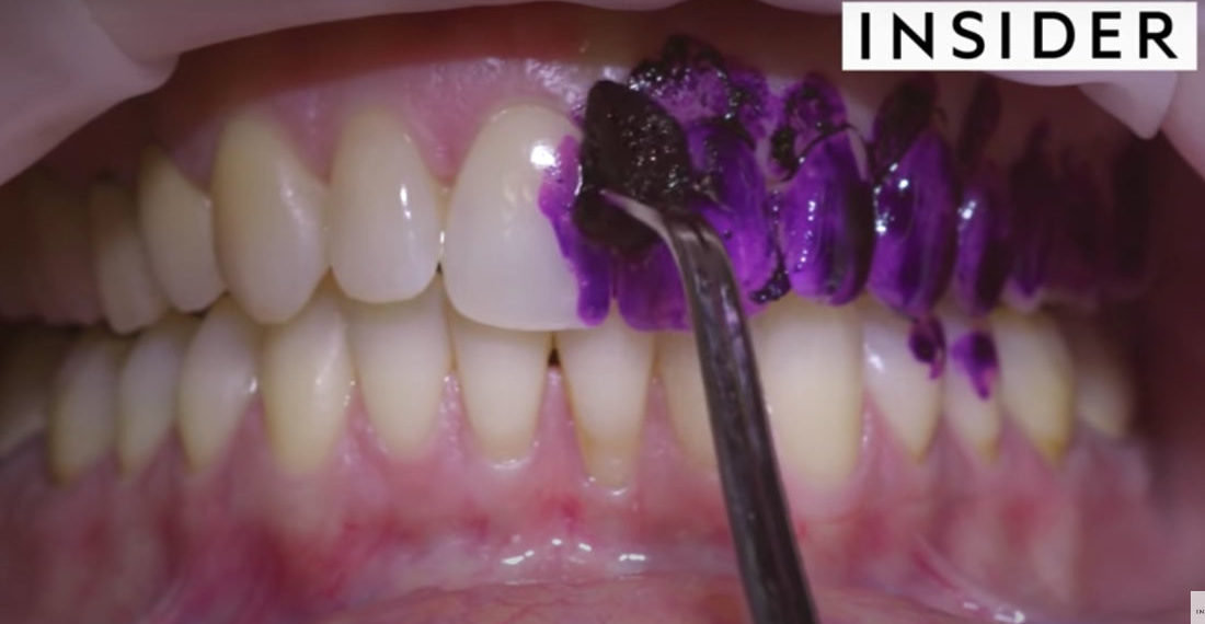 Satisfying/Disgusting: Video Of A Professional Teeth Deep Cleaning