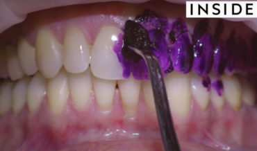 Satisfying/Disgusting: Video Of A Professional Teeth Deep Cleaning
