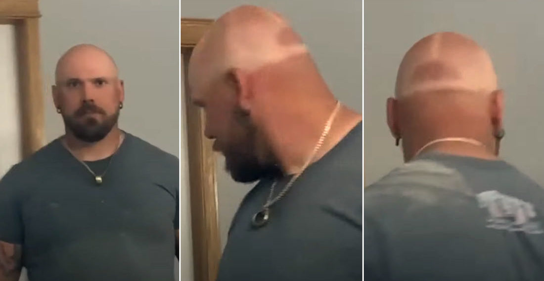 Man With Shaved Head Fails To Use Sun Protection, Gets Perfect Baseball Cap Tan