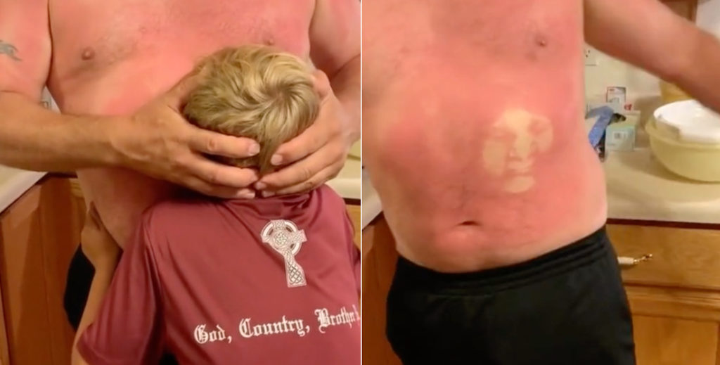 Sunburnt Man Mashes Kid's Face Into Belly To Leave Imprint