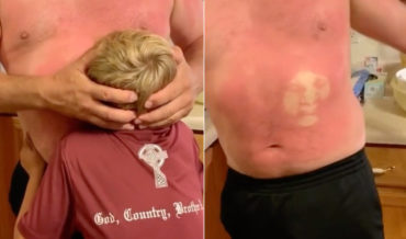 Sunburnt Man Mashes Kid’s Face Into Belly To Leave Imprint