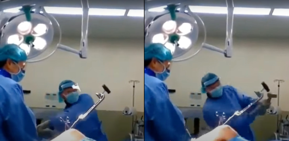Orthopedic Surgeon Removes Rod From Femur By Swinging For The Fences
